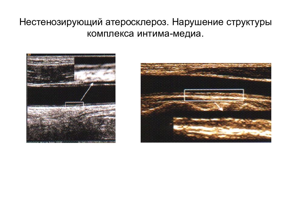 Признаки атеросклероза брахиоцефальных артерий. Атеросклероз сосудов УЗИ. Атеросклероз асл бляшка УЗИ. Нестенозирующий атеросклероз.