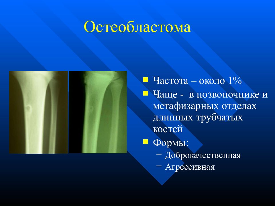 Чаще 1. Остеобластома плечевой кости. Остеобластома бедренной кости. Опухоль длинных трубчатых костей. Остеобластома агрессивная.