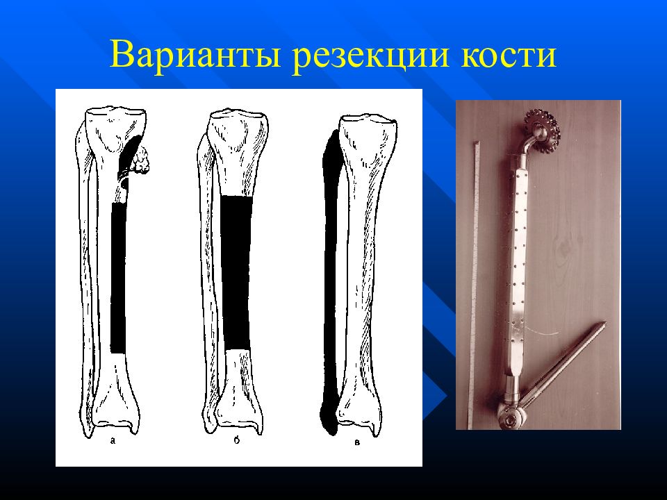 Уровень кость. Сегментарная резекция кости. Корытообразная резекция кости. Чрезнадкостничная резекция кости. Резекция плечевой кости.