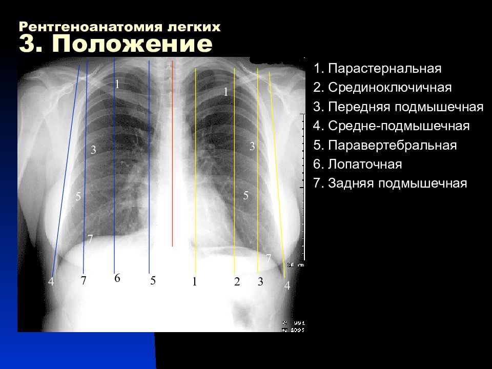 Положение легких. Ренгкнанатомия легких. Рентген АНАТОМИЯЛЕГКИХ. Рентгеноанатомия легких. Рентген легких анатомия.