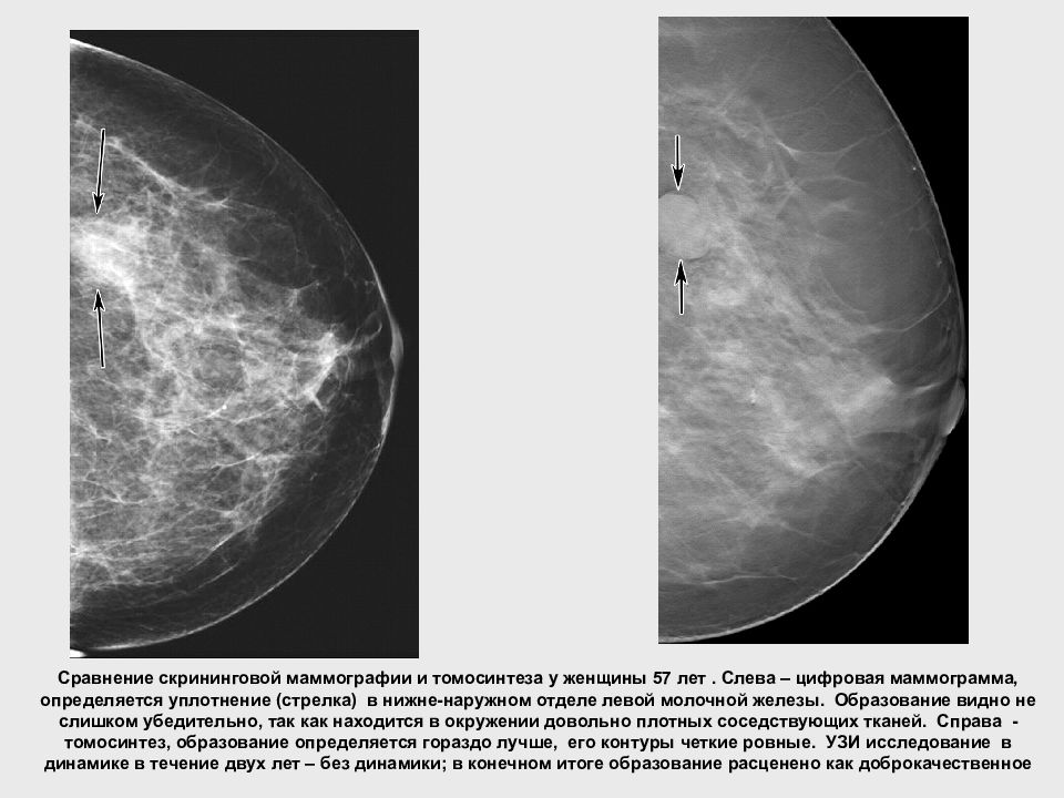 Маммография уплотнения. Норма молочной железы маммограмма. Фиброзно-кистозная мастопатия рентген. Фиброзно кистозная мастопатия маммограмма. Маммография рентген молочной железы.