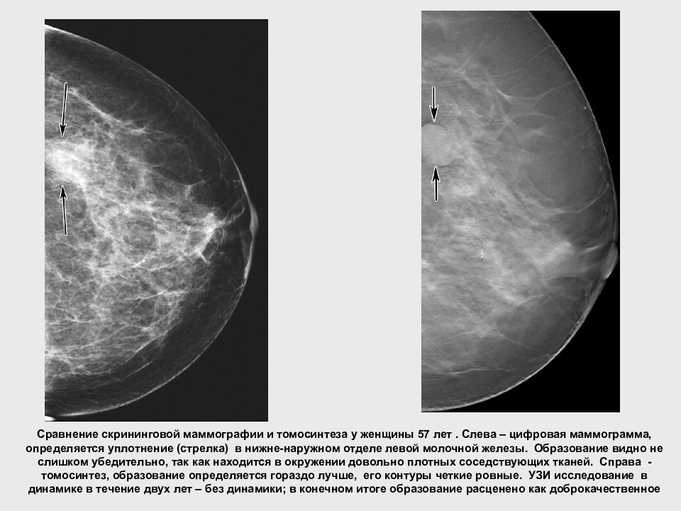 Железа в железе маммография. Маммограмма молочных желез норма. Норма молочной железы маммограмма. Молочные железы маммография норма. Молочная железа в норме маммография.