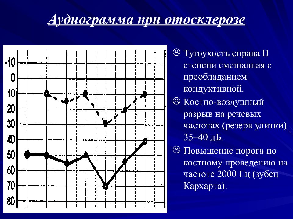 Аудиограмма это