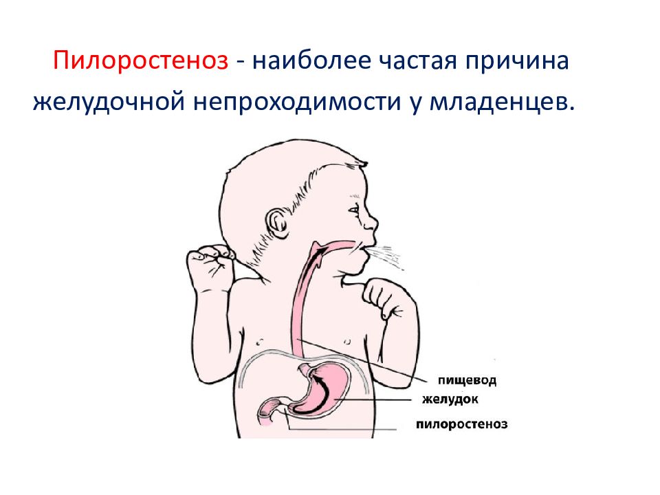 Пилороспазм у детей презентация