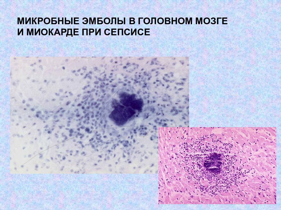 Патологическая анатомия сепсиса презентация