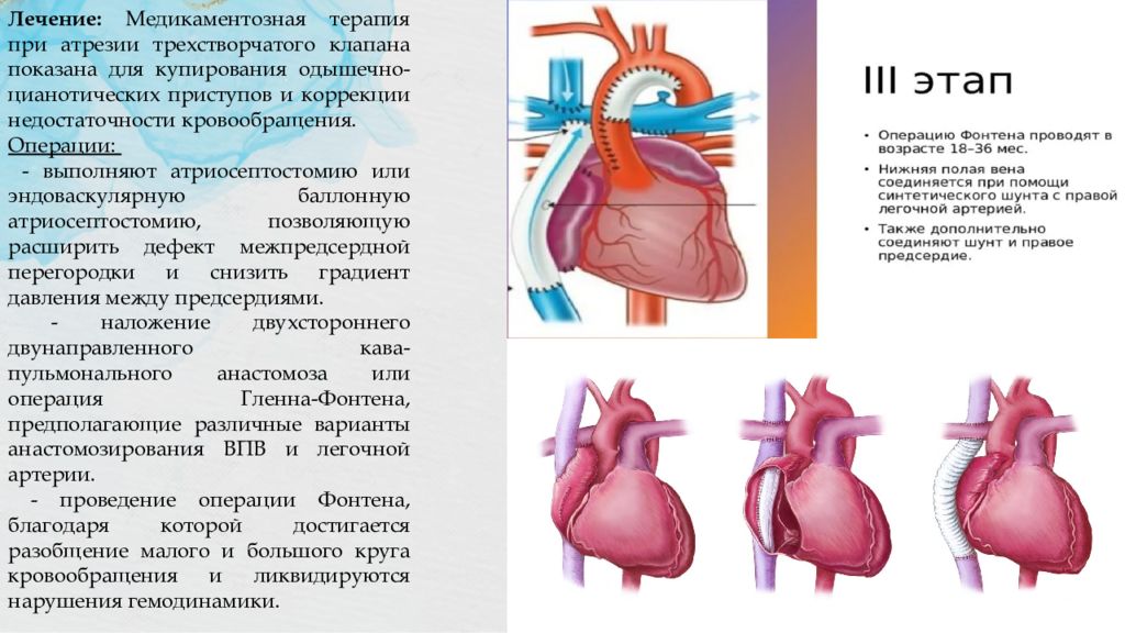 Стол при пороках сердца