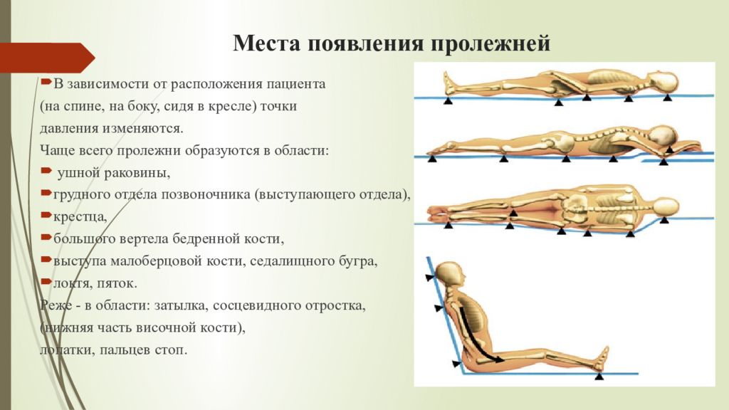 Образование пролежней. Частые места образования пролежней. Места образования пролежней в положении сидя. Места образования пролежней у пациента лежащего на животе. Силы, вызывающие образование пролежней пациент:.