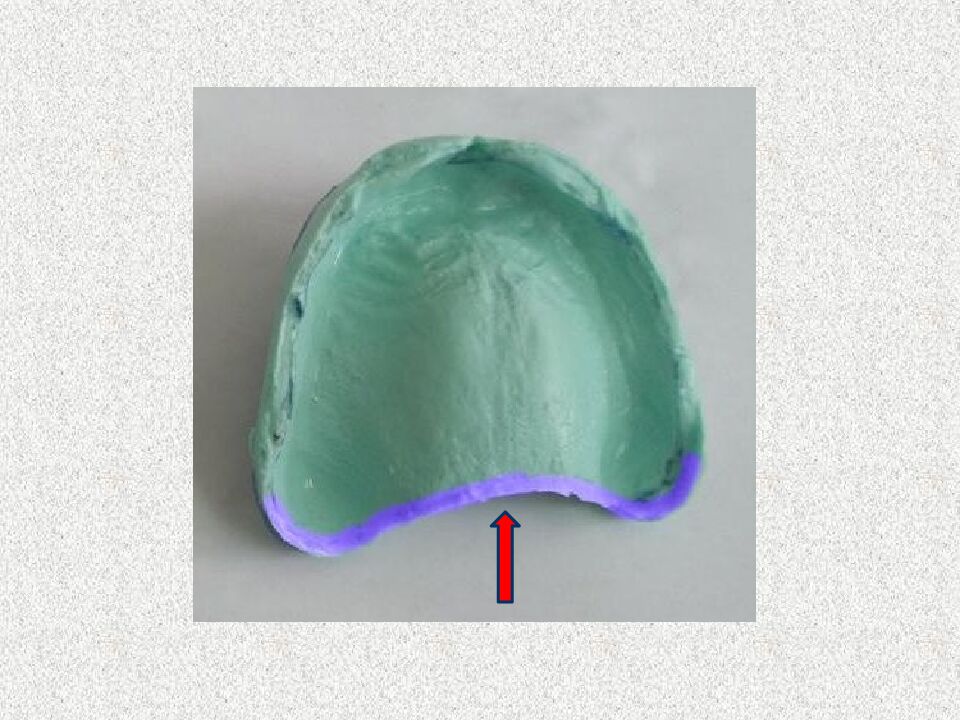 Funksional otisklar uchun individual qoshiqchalar