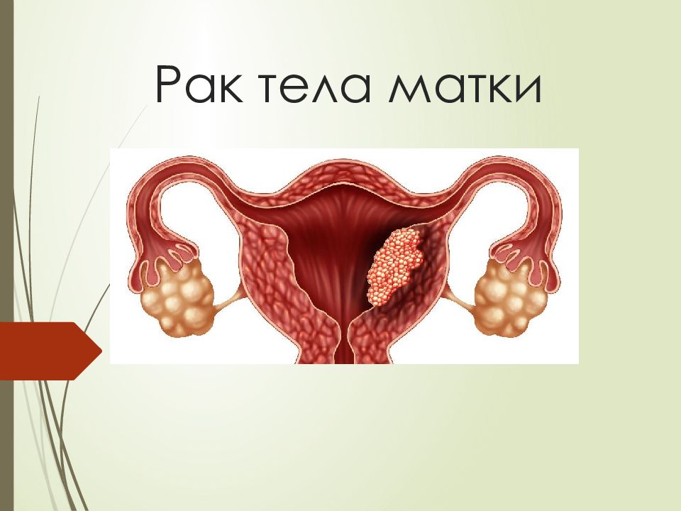 Рак тела матки