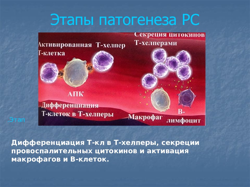 лечение рассеянного склероза стволовыми клетками