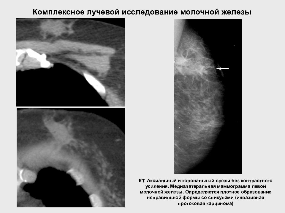 Признаки аденоза молочных желез. Методы лучевого исследования молочных желез. Рентгенодиагностика заболеваний молочной железы. Лучевая диагностика молочной железы. Лучевой метод исследования молочной железы.