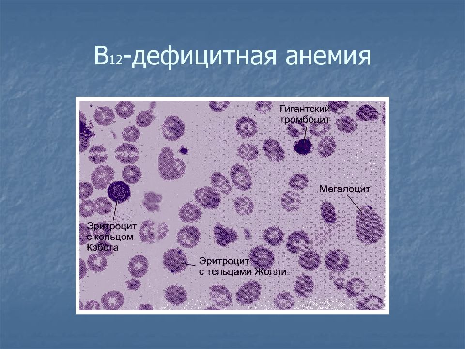 Анемия при дефиците в12. Витамин-b12-дефицитная анемия. Витамин-b12-дефицитная анеми. B12 фолиеводефицитная анемия. Б 12 дефицитная анемия картина крови.