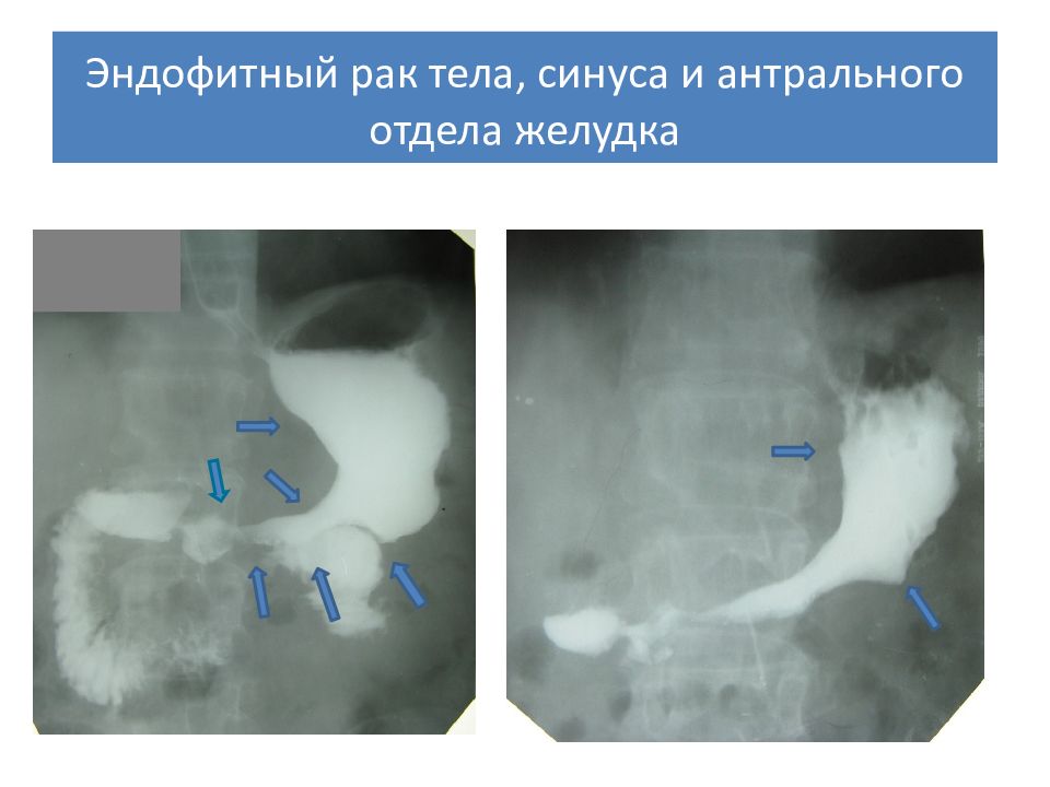 Эндофитный рост опухоли рисунок