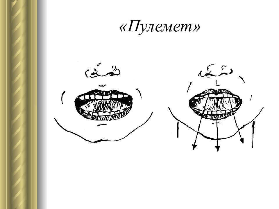 Артикуляция при дизартрии. Перекос языка при дизартрии. Профилактика дизартрии задания и упражнения. Дизартрия рисунки рта как выглядит норма.