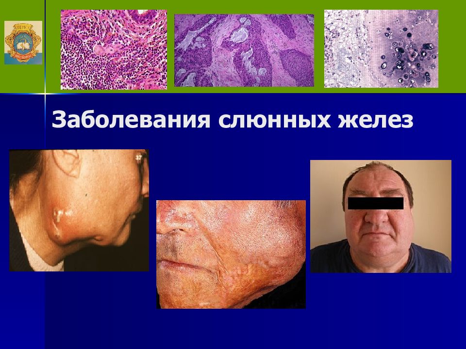 Заболевания слюнных желез