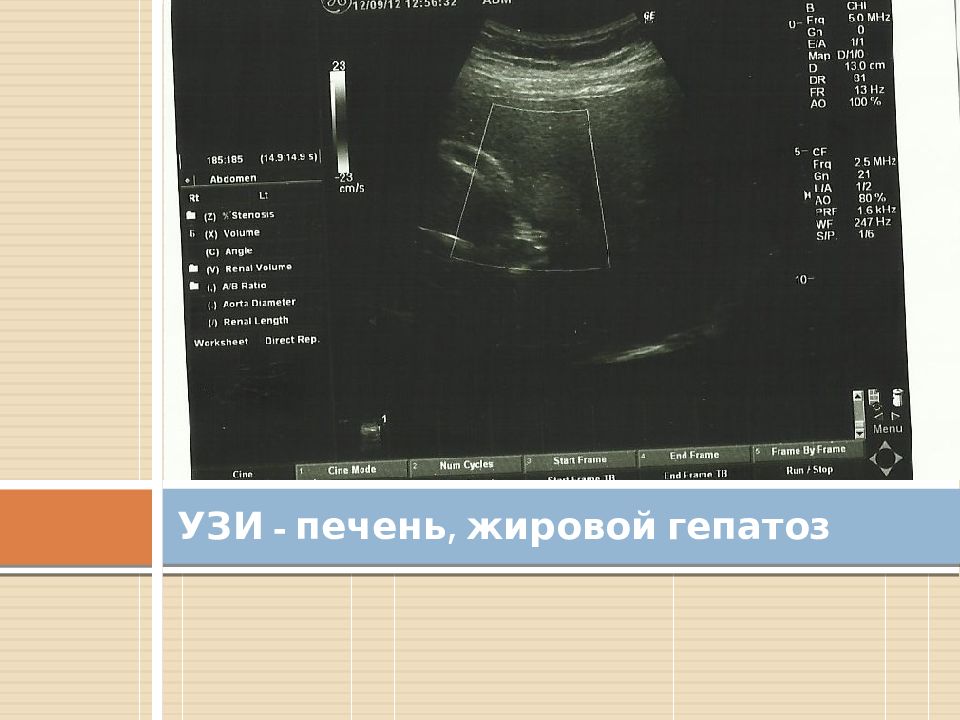 жировая инфильтрация печени на узи. жировая инфильтрация печени узи картина. узи печени при жировом гепатозе. жировая дистрофия печени на узи. формы жирового гепатоза по узи.