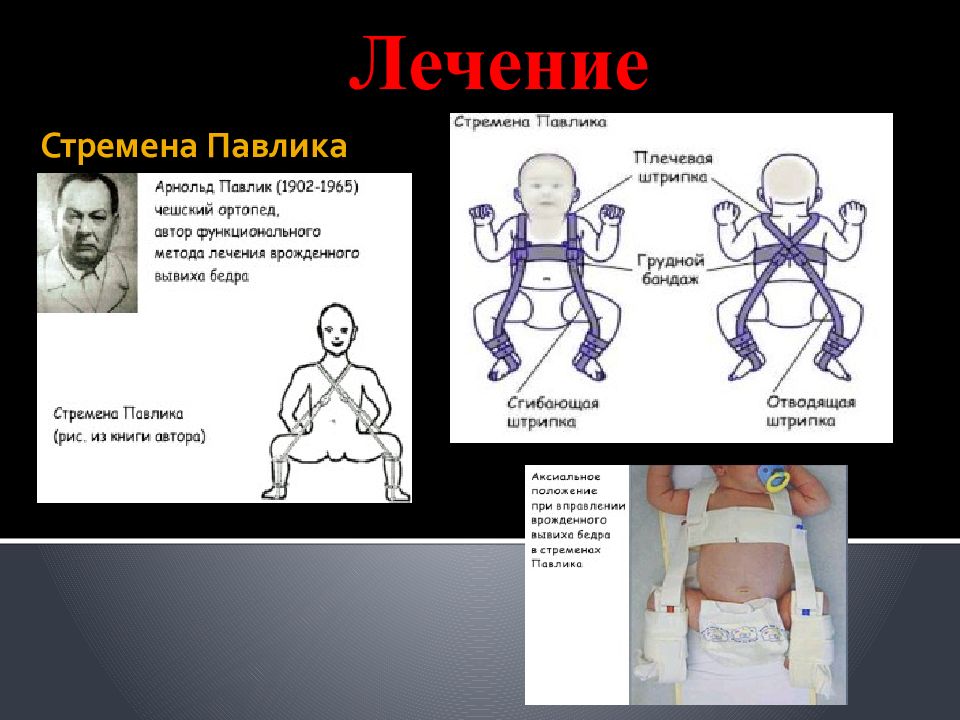 Врожденный вывих бедра презентация