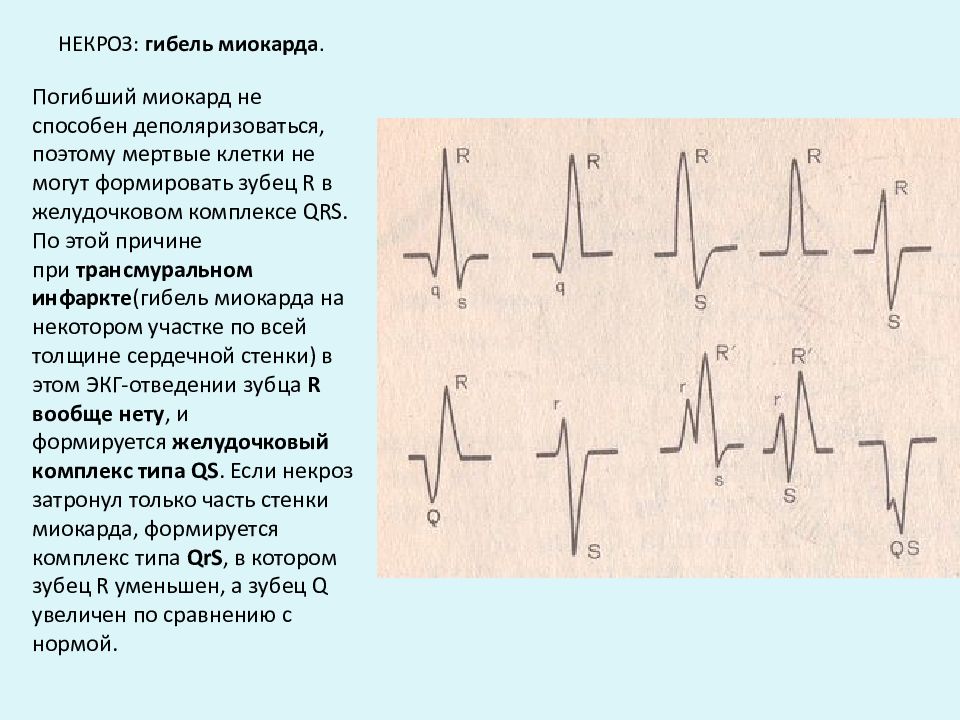 Инфаркт миокарда карта смп