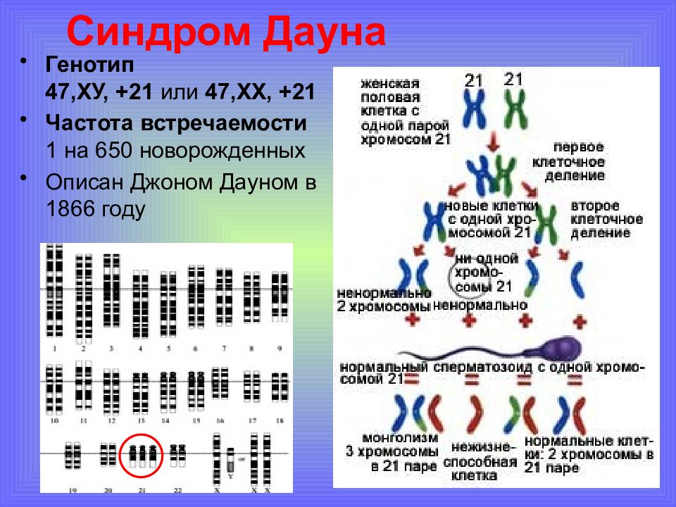 Синдром дауна код. Синдром Дауна хромосомная карта. Кариотип человека при синдроме Дауна. Синдром Дауна генетическая карта. Болезнь Дауна кариотип.
