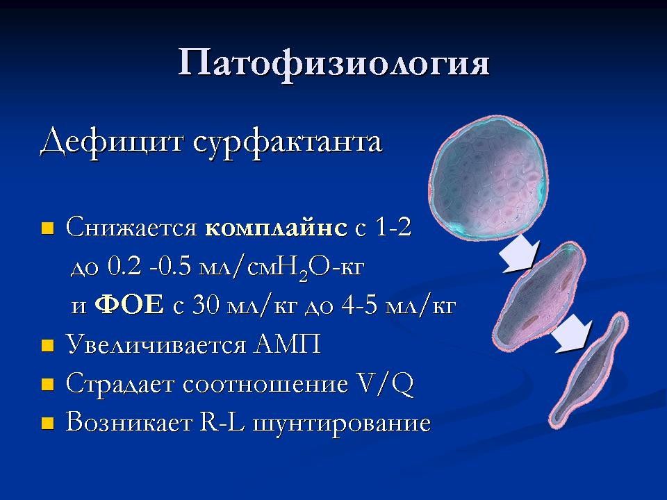 Респираторный дистресс синдром новорожденных презентация