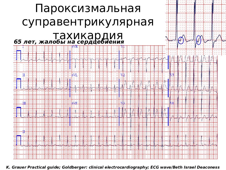 Пароксизмальная тахикардия на экг. Суправентрикулярная тахикардия (свт) ЭКГ. Пароксизм свт ЭКГ. Пароксизмальная наджелудочковая тахикардия (свт) на ЭКГ. ЭКГ признаки суправентрикулярной тахикардии.