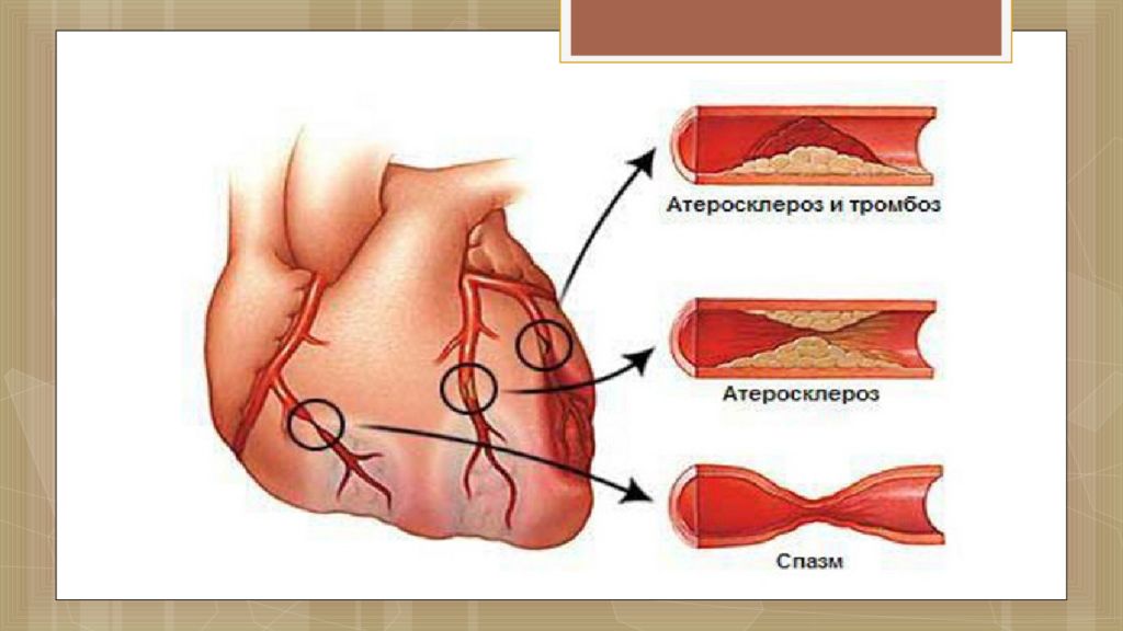 Ишемия передней стенки. Ишемическая болезнь сердца. Спазм коронарных артерий. Спазм венечных сосудов.
