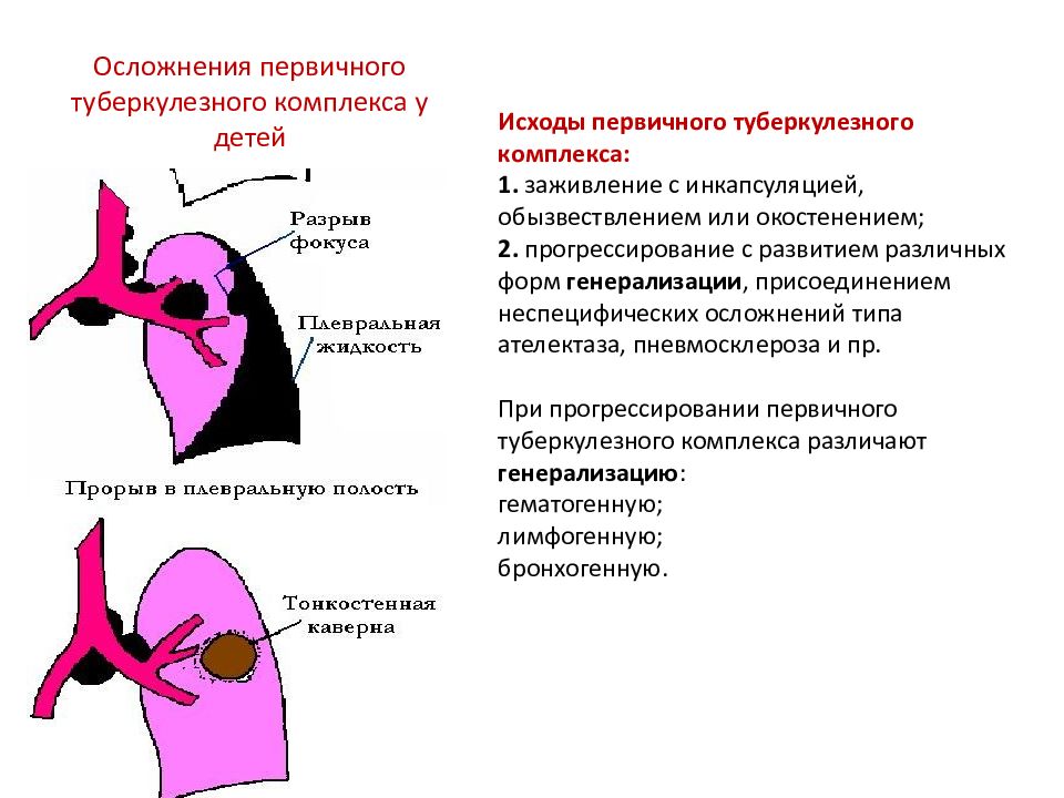 Исходы туберкулеза легких