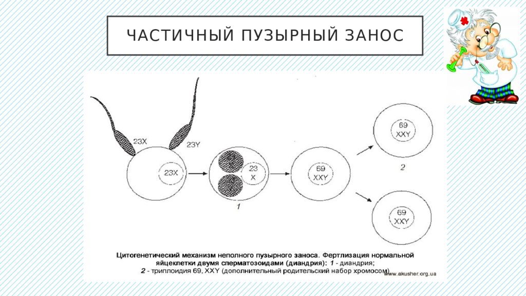 Пузырный занос. Полный пузырный занос кариотип. Частичный пузырный занос. Xастичный пузырный занос. Кариотип при пузырном заносе.