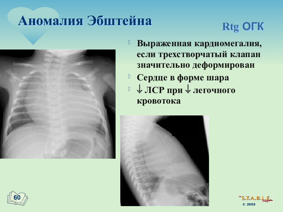 Деформировано сердце