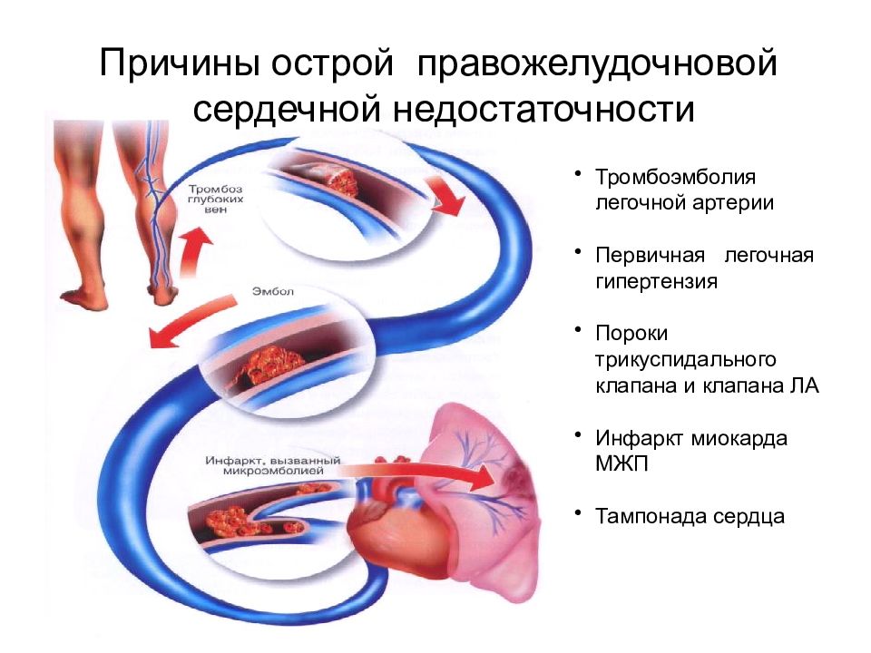 Сердечная недостаточность тромбоэмболия. Острая сердечно-легочная недостаточность. Сердечно-сосудистая недостаточность. Острая сердечно-сосудистая недостаточность причины. Легочно-сердечная недостаточность.