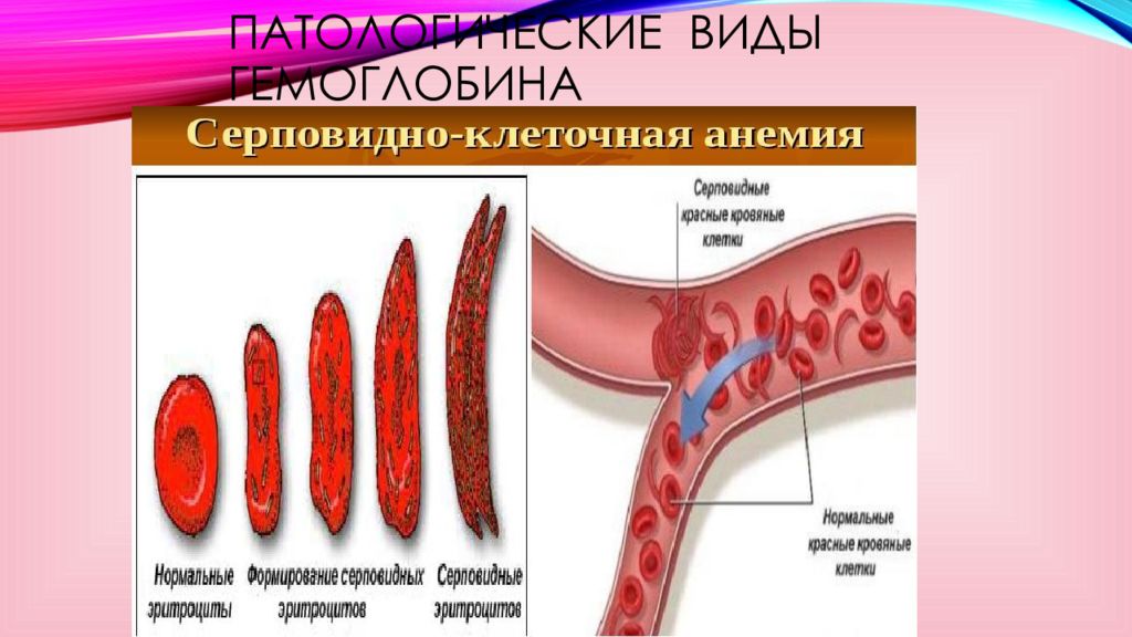 Физиологические соединения гемоглобина. Патологический гемоглобин. Сульфгемоглобин биохимия. Аномальные виды гемоглобина. Аномальный гемоглобин формула.