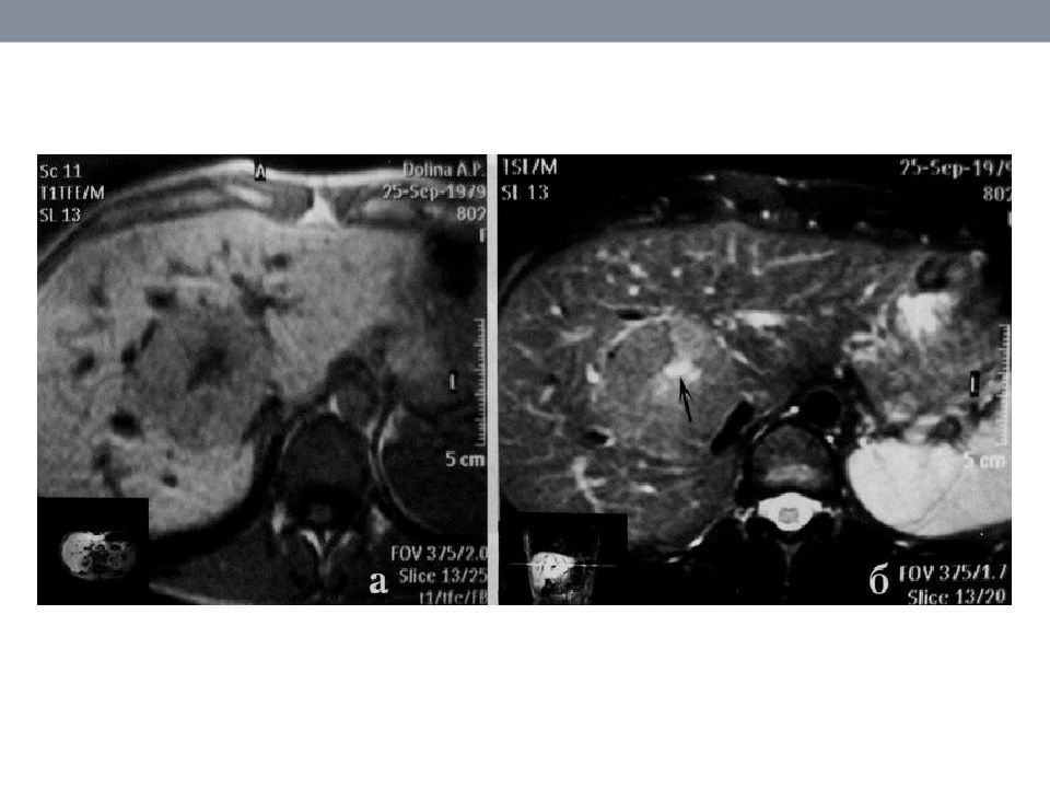 Образования печени мрт. Дифференциальная диагностика образований печени на кт. Образования печени мрт диагностика. Дифференциальный диагноз при кт и мрт.