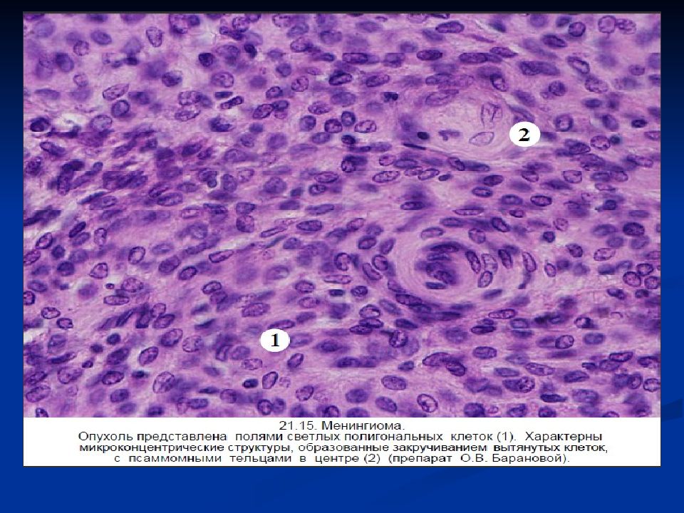 Мезенхимальные опухоли патанатомия презентация