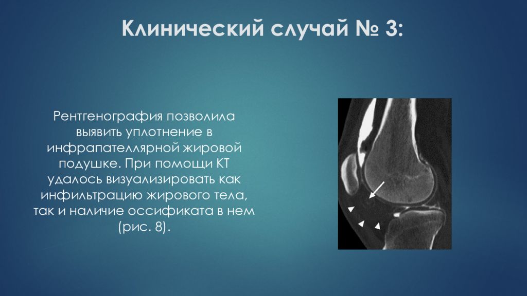 Отек клетчатки. Жировое тело Гоффа мрт. Болезнь жирового тела Гоффа мрт. Гипертрофированное жировое тело Гоффа. Киста жирового тела Гоффа.