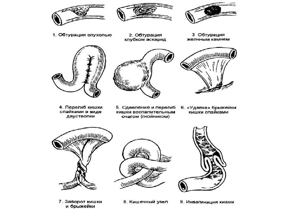 Кишечная непроходимость патофизиология презентация