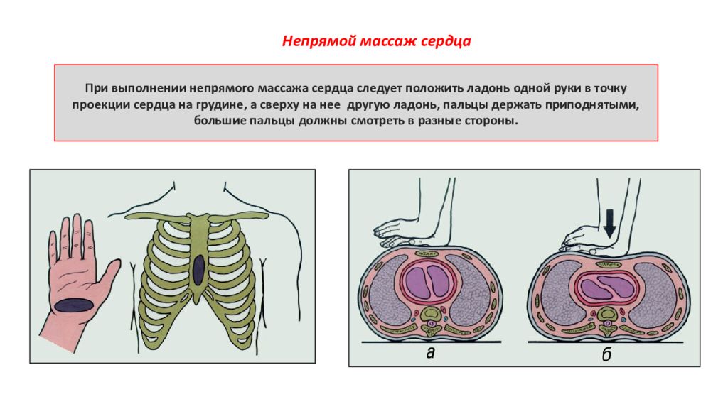 Сердечный массаж. Закрытый массаж сердца техника. Непрямой массаж сердца техника выполнения. Техника проведения непрямого массажа сердца. Непрямой закрытый массаж сердца.