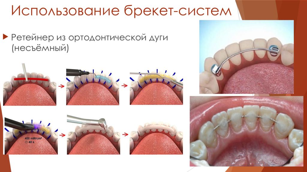 Ретенционные аппараты презентация