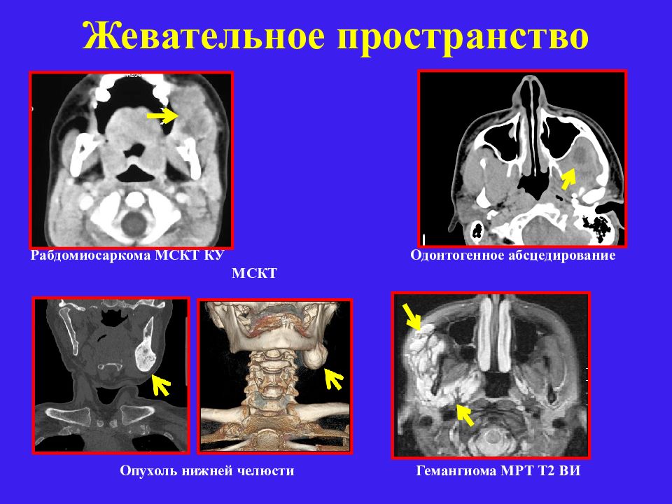 Пространство кт. Жевательное пространство. Жевательное пространство мрт. Жевательное пространство кт.