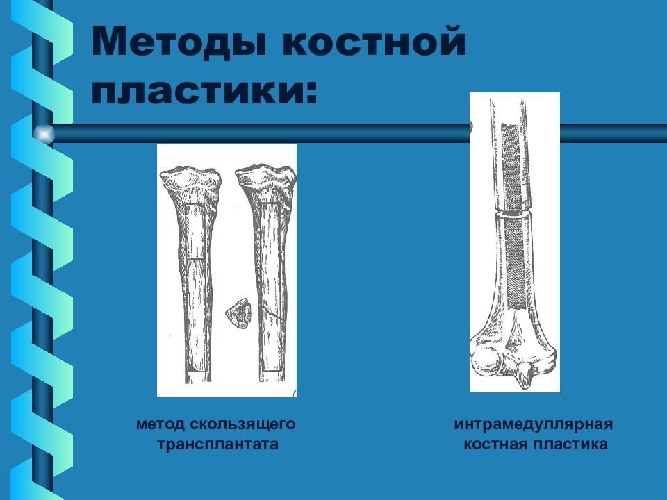 Костную пластику. Интрамедуллярная костная пластика. Костная пластика по чаклину Хахутову. Методы костной пластики. Костная пластика скользящим трансплантатом.