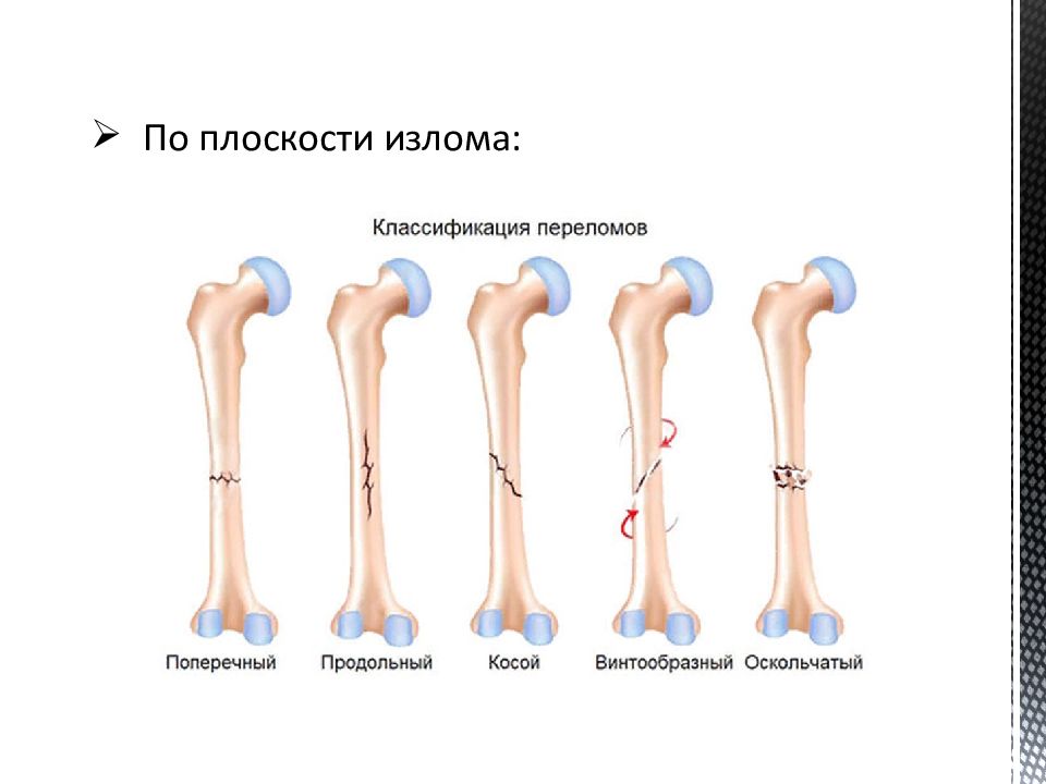 Удобная кость. Схема переломов трубчатых костей. Классификация переломов по плоскости излома. Переломы длинных трубчатых костей. Классификация переломов трубчатых костей.