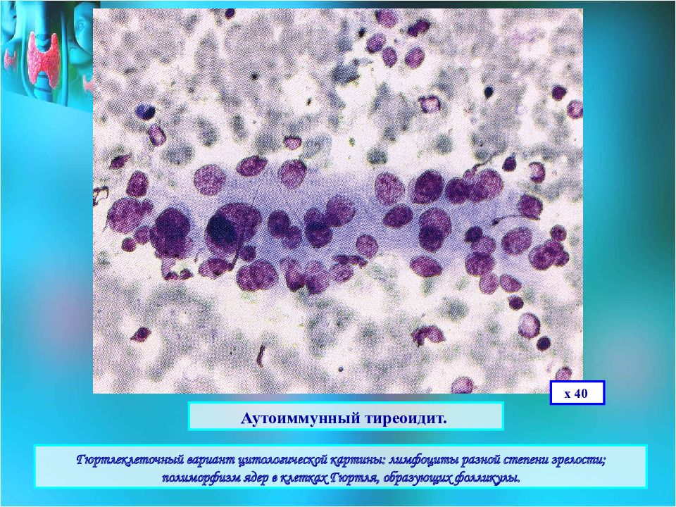 Цитологическая картина фолликулярной опухоли щитовидной железы что значит