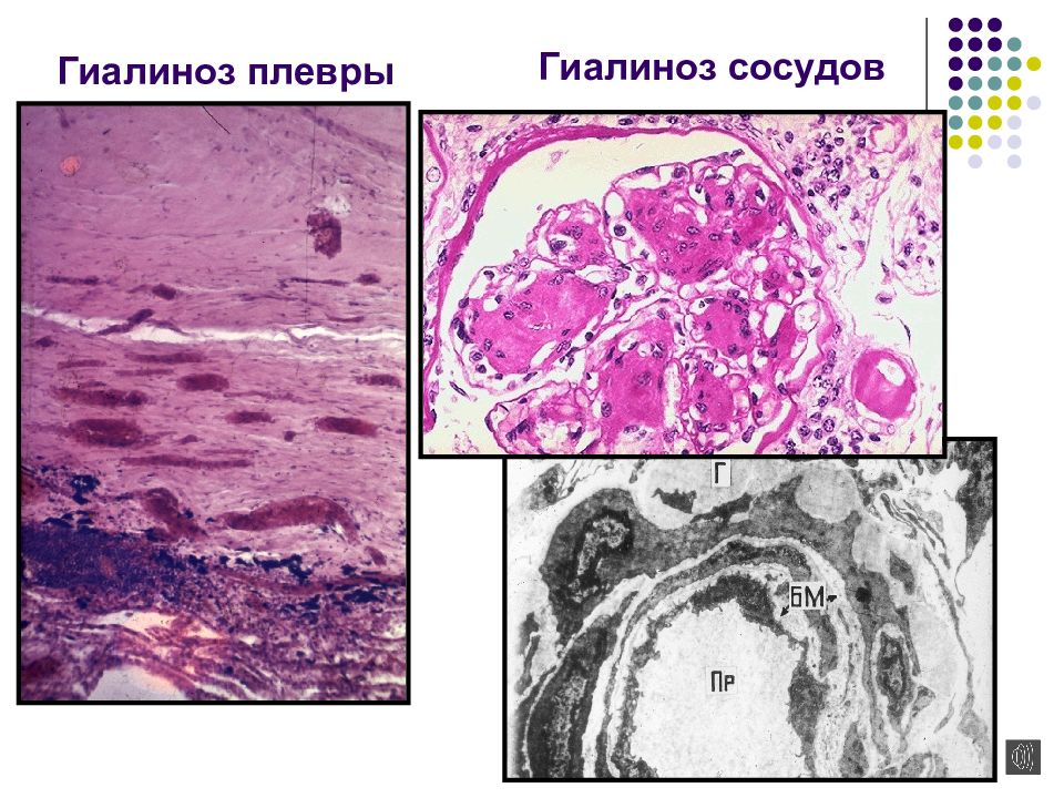 Гиалиноз плевры рисунок