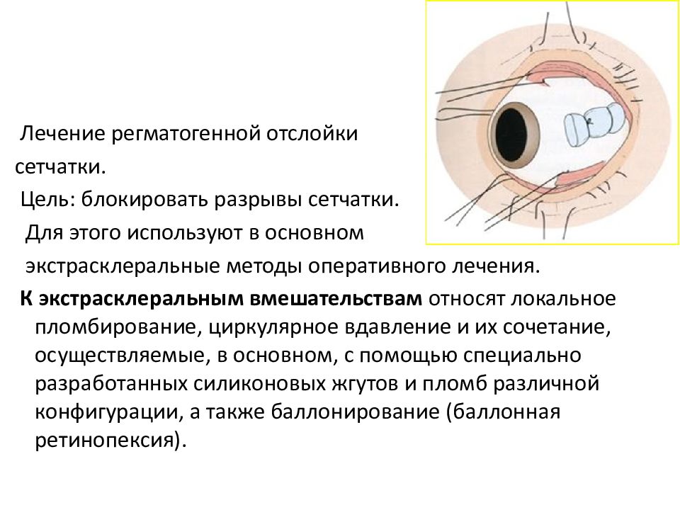 Пломбирование сетчатки. Отслойка сетчатки экстрасклеральное. Эписклеральное пломбирование сетчатки. Пломбирование глаза при отслоении сетчатки. Регматогенная отслойка сетчатки симптомы.