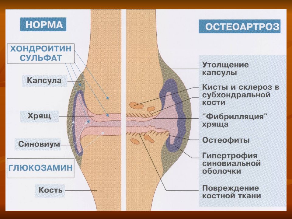 Остеоартроз патогенез