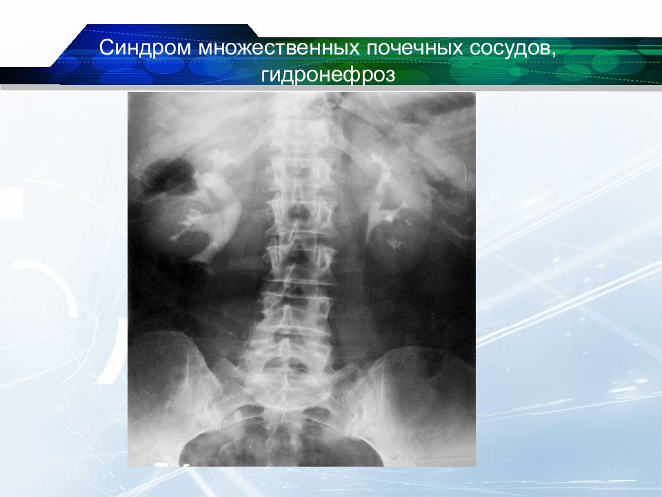 Диагноз аномалия. Гидронефроз почек аномальный сосуд. Множественная почка фото. Функциональный гидронефроз на фоне аномалия нервной системы.