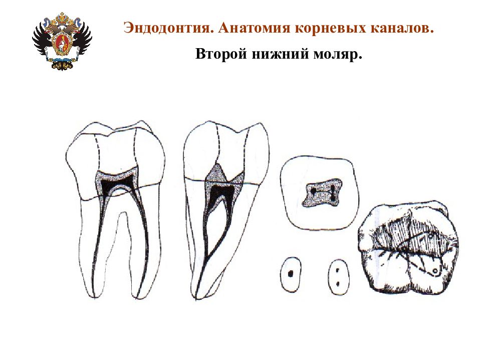 Анатомия каналов. Второй моляр нижней челюсти анатомия корневых каналов. Нижний 2 моляр корневые каналы. 1 Моляр нижней челюсти анатомия корневых каналов. Топография корневых каналов нижних моляров.