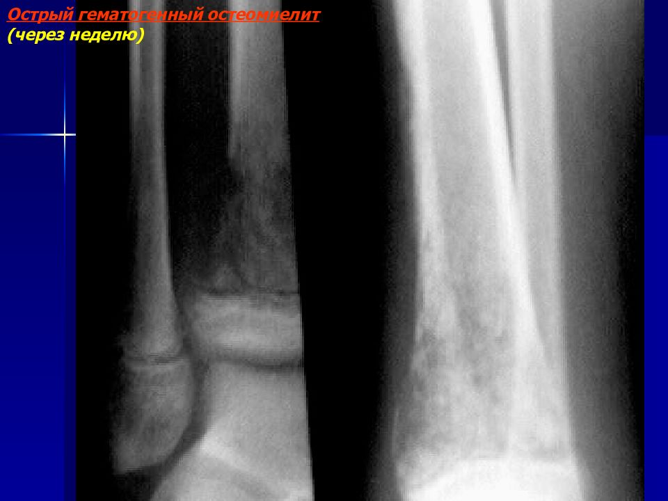Рентгенодиагностика остеомиелита презентация