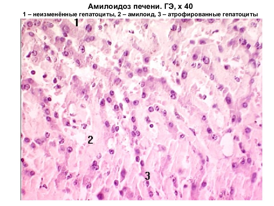 Амилоидоз печени презентация