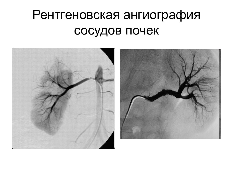 Почечная ангиография презентация