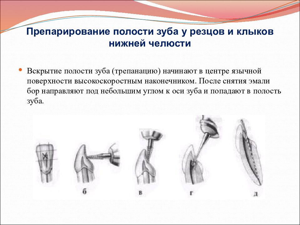 Методы лечения зубов с проблемными корневыми каналами презентация